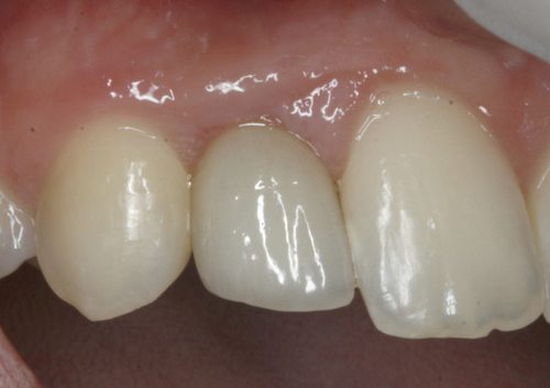 picture of teeth after a dental implant