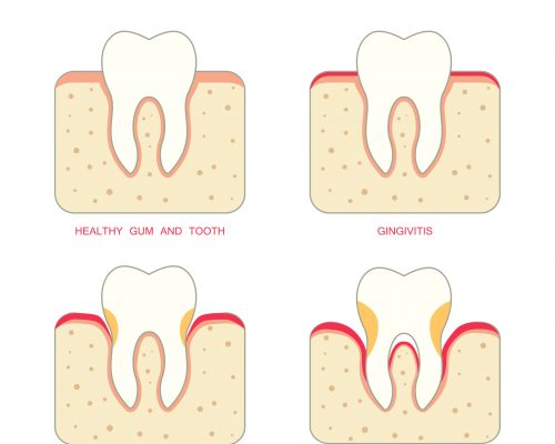 Periodontal disease