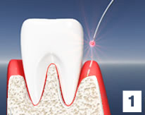 Gum Graft Idaho Falls