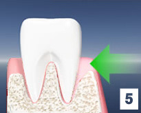 LANAP - Gum Disease Treatment